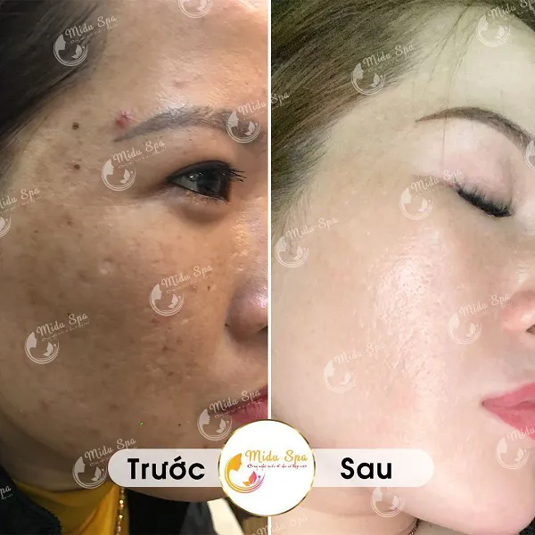 Midu Spa – Địa chỉ trị nám chân đinh uy tín tại quận 9