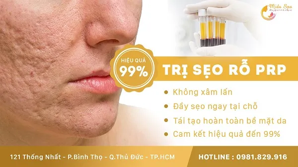 Midu Spa – Địa chỉ trị sẹo rỗ, lõm uy tín tại quận 9