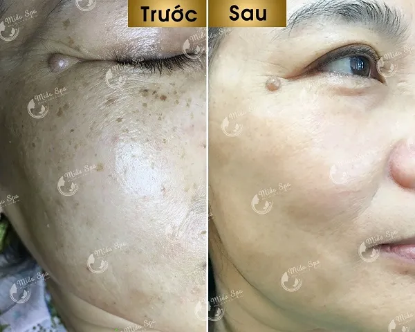 Midu Spa – Địa chỉ trị tàn nhang uy tín tại TP. Thủ Đức