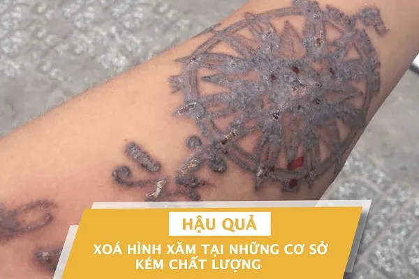 Midu Spa – Địa chỉ xóa hình xăm uy tín quận 9