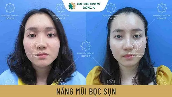 Top 10 địa chỉ nâng mũi đẹp và uy tín nhất tại Hà Nội