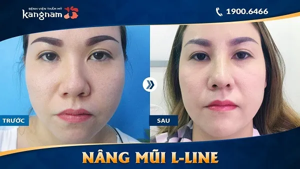 Top 10 địa chỉ nâng mũi đẹp và uy tín nhất tại Hà Nội