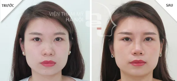 Top 10 địa chỉ tiêm Filler – Botox uy tín, an toàn nhất ở Hà Nội