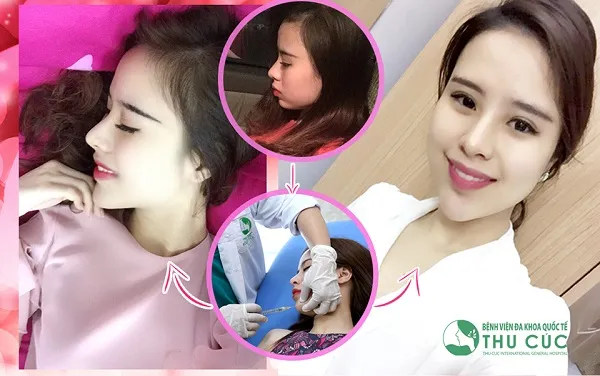 Top 10 địa chỉ tiêm Filler – Botox uy tín, an toàn nhất ở Hà Nội