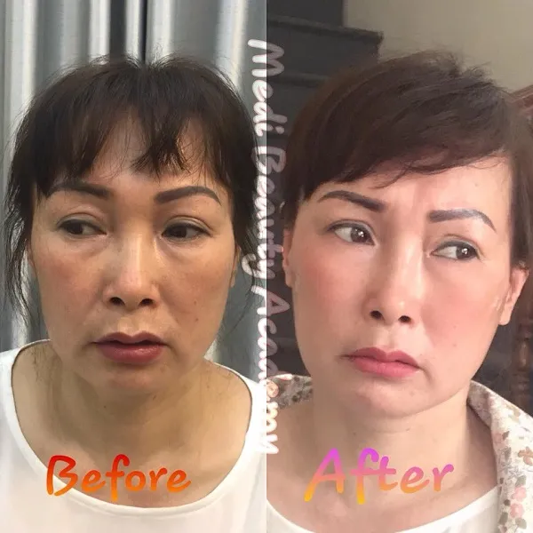 Top 10 địa chỉ tiêm Filler – Botox uy tín, an toàn nhất ở Hà Nội