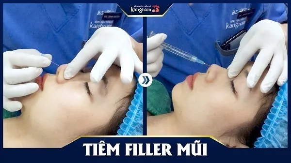 Top 10 địa chỉ tiêm Filler – Botox uy tín, an toàn nhất ở Hà Nội