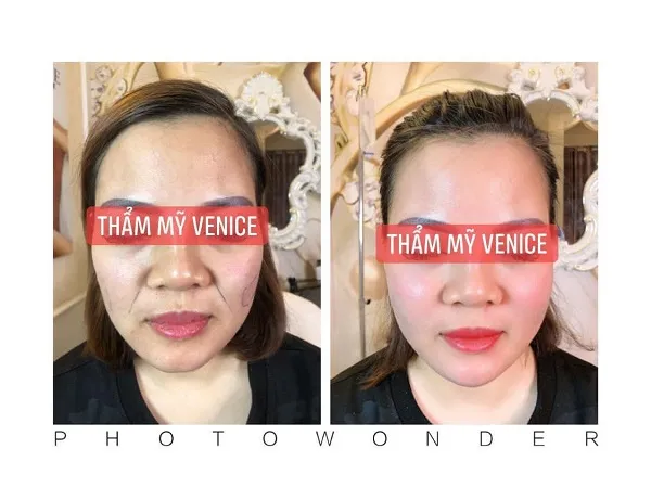 Top 10 địa chỉ tiêm Filler – Botox uy tín, an toàn nhất ở Hà Nội